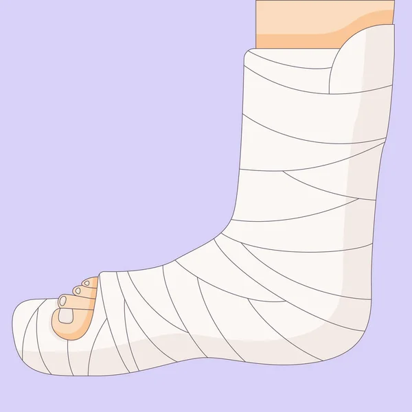 Broken leg in in a cast bandage, orthopedic gypsum, injury bone, vector illustration drawn in a flat style. — Stock Vector