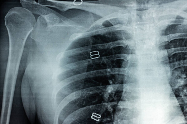 Film X-ray of breast a person, Film grain style