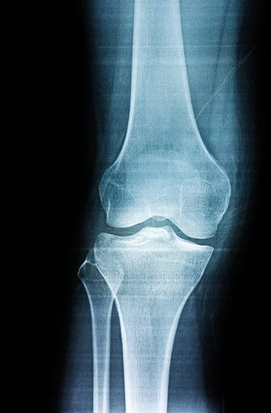 Film X-ray of a leg bone person, Film grain style