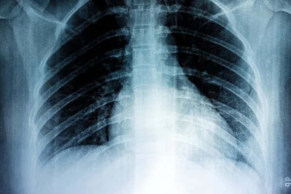 Рентген Плівки Грудей Людина Стиль Плівкового Зерна — стокове фото
