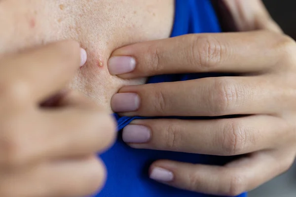 Woman Try Take Acne Her Chest Closeup Selective Focus — Stock Photo, Image