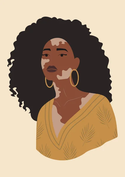 Young black woman with vitiligo poster — Vector de stock