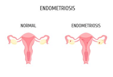 Endometriyozis olsun ya da olmasın, kadın üreme organları. Bilgi Grafikleri. 