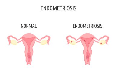 Female genital organs with and without endometriosis. Infographics.  clipart