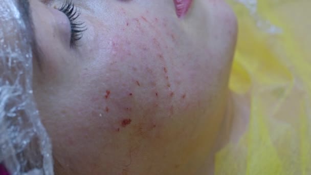 Conceito Beleza Injeção Cosmetologia Clínica Esteticista Experiente Usando Luvas Brancas — Vídeo de Stock