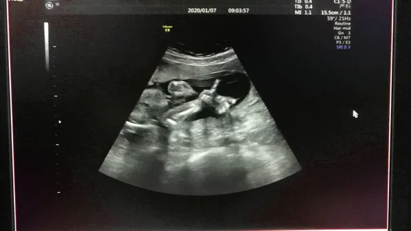 x-ray scan of the ultrasound of the heart