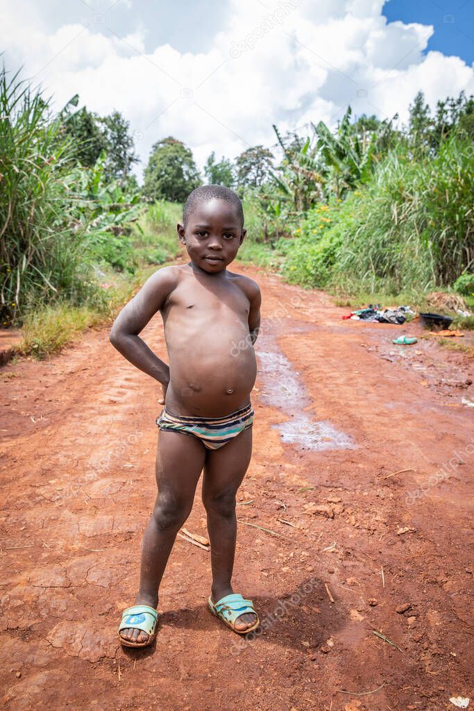 African child suffering from Kwashiorkor. His belly is swollen from malnutrition.
