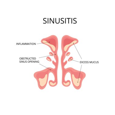 Aşırı mukus ve tıkanmış sinüs açıklıklarıyla enfeksiyon kapmış sinüs. Enfeksiyon, burun hastalığı, anatomi. Teşhis, tıkanıklık, grip gibi konularda kullanılabilir.