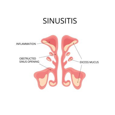 Inflammated sinus with excess mucus and obstrusted sinus openings. Infection, nasal disease, anatomy. Can be used for topics like diagnosis, congestion, flu clipart