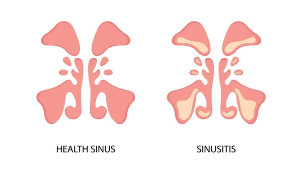 Imagen Plana Sinusitis Sinusitis Sinusal Saludable Infección Inflamación Enfermedades Nasales — Vector de stock