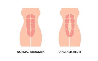 Karın kasları ve diastasis recti normal. Karın boşluğu olarak da bilinir. Hamile kadınlarda yaygındır.