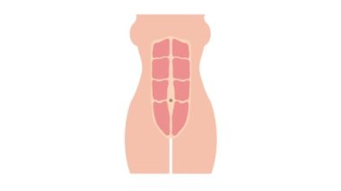Diastasis recti animasyonunun oluşumu normal tonlu karın kaslarından, ayrıca karın boşluğu olarak da bilinir, hamile kadınlar arasında yaygındır. 