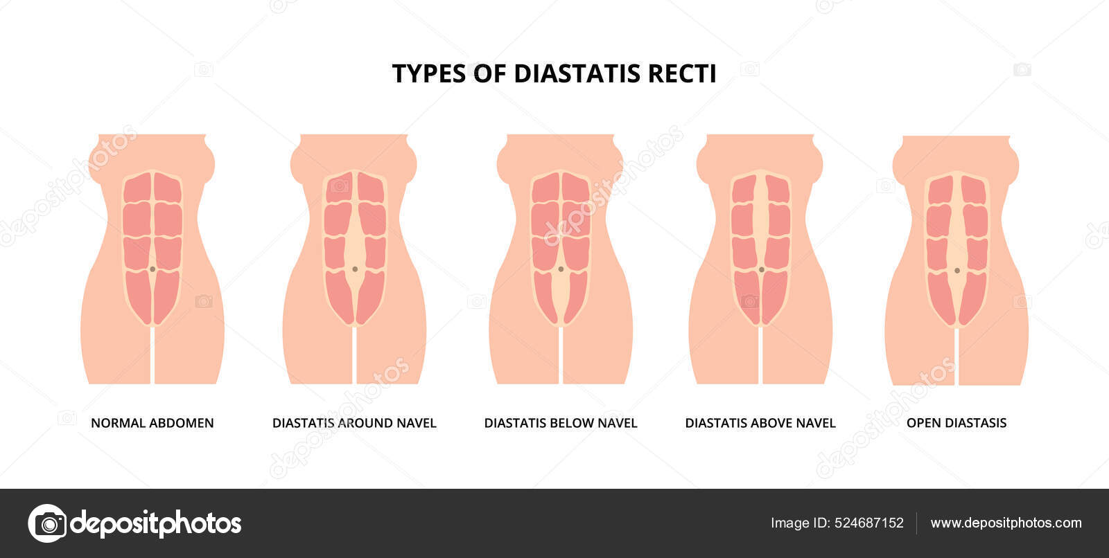 Types Diastasis Recti Also Known Abdominal Separation Common