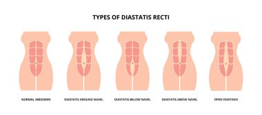 Abdominal ayrılma olarak da bilinen diastasis recti türleri, hamile kadınlar arasında yaygındır. Karın kasları, anatomi, doğum sonrası bakımı. 
