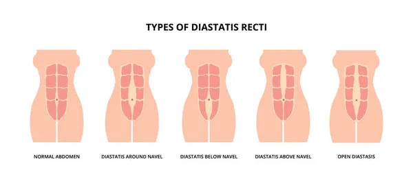 Tipos Diastasis Recti También Conocida Como Separación Abdominal Común Entre — Vector de stock