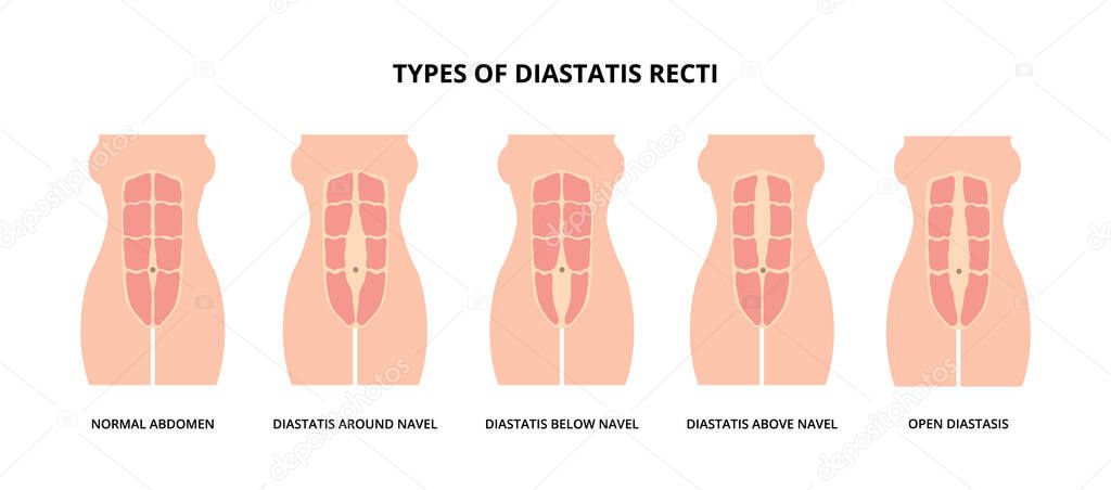 Types of diastasis recti, also known as abdominal separation, common among pregnant women. Abdomen muscles, anatomy, postpartum care 