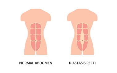 İnsan ve diastasis recti 'nin normal karın kasları. Abdominal ayrılma olarak da bilinir. Erkek vücudu, sağlık, spor 