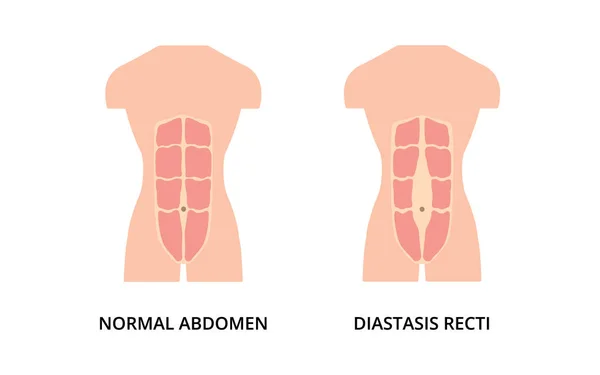Normalerweise Durchtrainierte Bauchmuskeln Des Menschen Und Diastasis Recti Auch Als — Stockvektor