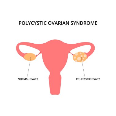 Polycystic ovarian syndrome. Uterus, infertility, gynecology. For topics like pcos, disease, pelvic floor clipart
