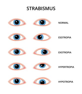 Strabismus türleri. Esotropi, ekzotropi, hipotropi ve hipotropisi olan gözler. Görme, göz muayenesi, göz doktoru.