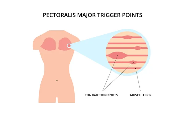 Pectoralis Muscle Trigger Point Myofascial Release Physical Therapy Anatomy Medicine — ストックベクタ