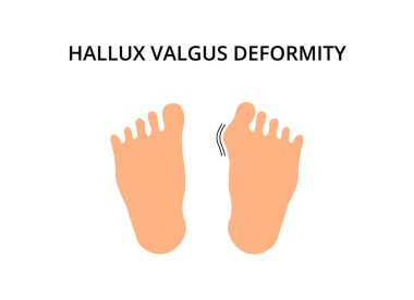Ayağında hallux valgus deformasyonu var. Nasır, sorun, ortopedi. Semptom, kemik, ayak hastalıkları gibi konular için