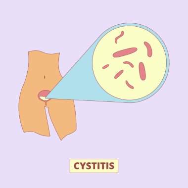 Sistit, idrar kesesi illüstrasyonunda bakteriyel enfeksiyon. Kadın sağlığı, hastalık, üroloji. İltihap, ishal, teşhis gibi konular için.