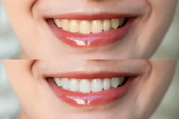 Frauenzähne Vor Und Nach Der Zahnaufhellung Blickt Die Kamera Zahnklinik — Stockfoto