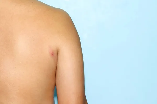 Inflamed Acne Back Person — Stock Photo, Image