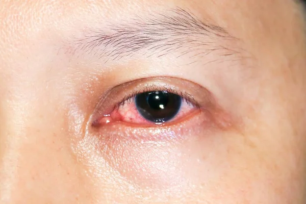 Закрыть Глаза Инфекция Конъюнктивит — стоковое фото