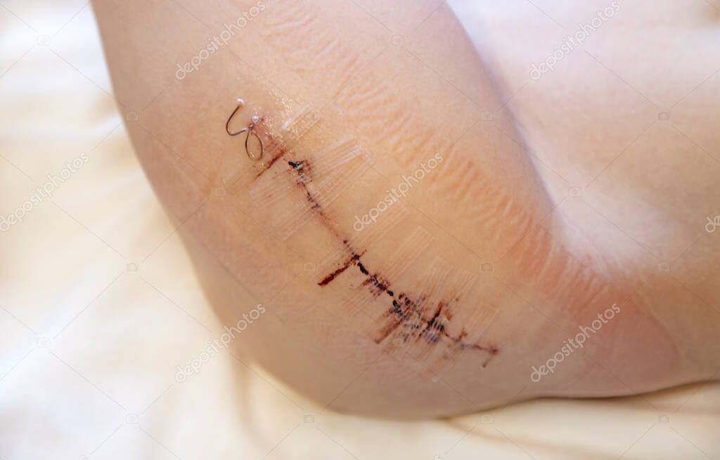 scar from surgery on a childs leg with black fiber. Hip surgery
