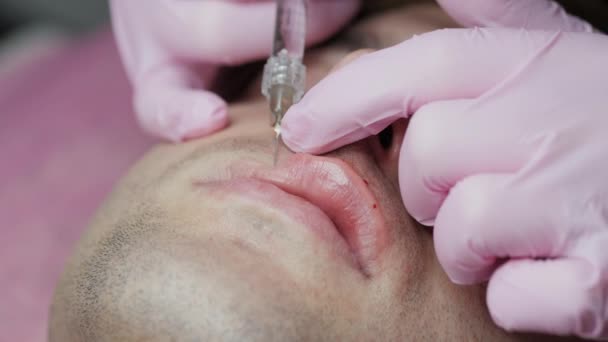 Man får skönhetsinjektion för läppar. Närbild av händer kosmetolog gör injektion i manliga läppar. Läppförstoring — Stockvideo