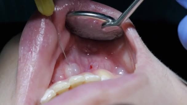Zbliżenie, dentysta daje zastrzyk znieczulenia do kobiety pacjenta przed zabiegiem stomatologicznym — Wideo stockowe
