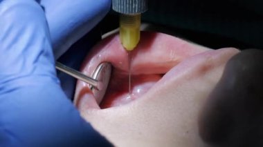 Yakın plan, dişçi diş tedavisinden önce kadın bir hastaya anestezi enjekte eder.