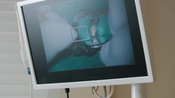 Vista de la pantalla del monitor durante el procedimiento dental, tratamiento para un paciente a través de un microscopio — Vídeo de stock