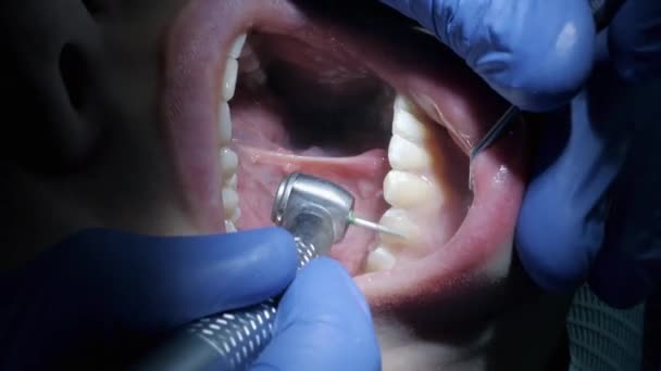 Detailní Záběr Zubař Vymazává Smalt Zubů Pacientů Instalovat Dýhy — Stock video