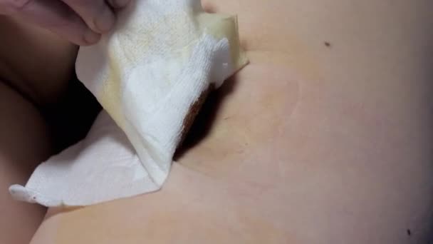 Remove Gesso Ferida Cuidados Ferida Após Cirurgia Para Remover Uma — Vídeo de Stock