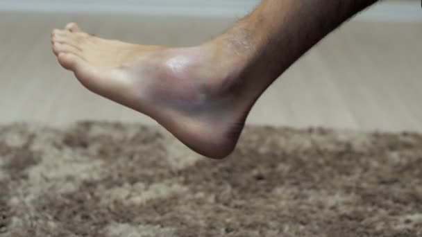 Close Mans Hand Touches His Foot Big Bruise Home Sprain — Vídeo de Stock