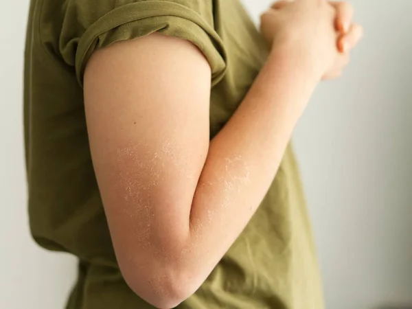 Peeling Haut Der Schulter Von Sonnenbrand Wirkung Auf Den Körper — Stockfoto