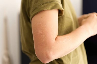 Genç bir kadının vücudunda güneş yanığı etkisinden derisi soyuluyor. Kırmızı güneş yanığı ten konsepti olan bir kız. Kapat.