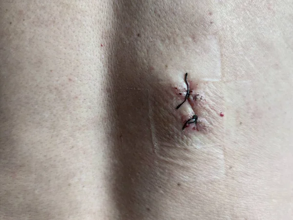 Postoperative Healing Suture Human Skin Black Medical Thread Operation Back — Stock Photo, Image