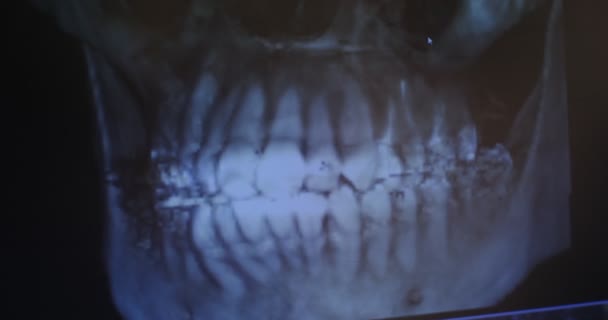 Immagine a raggi X della mandibola dei pazienti sul monitor medico, primo piano. — Video Stock