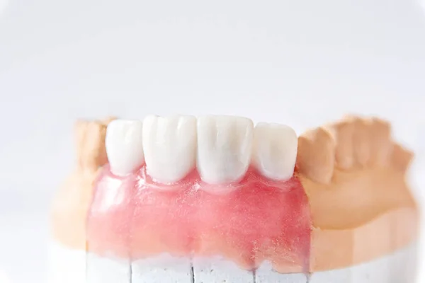 Dentadura Hecha Cerámica Ubicada Modelo Yeso — Foto de Stock