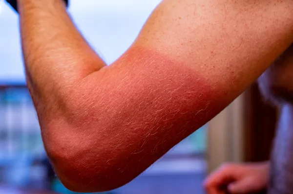 Braço com queimadura solar vermelha visível causada pelo uso de uma camisa — Fotografia de Stock