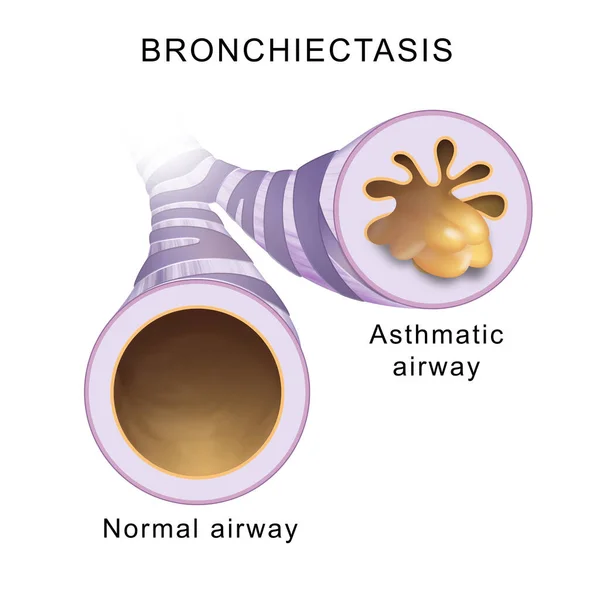 Bronchiectasis Normal Airway Asthmatic Airway — Fotografia de Stock