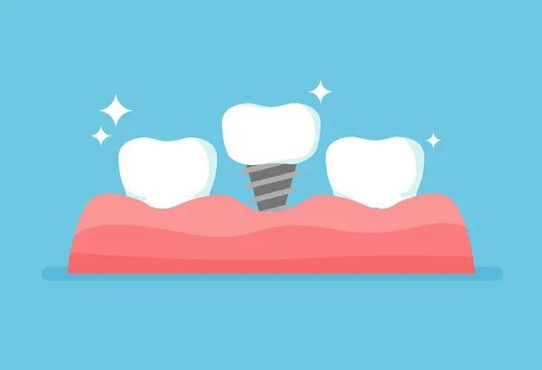 Zahnreihe Mit Zahnimplantat Konzept Zur Zahnsanierung Vektordarstellung Isoliert Auf Blauem — Stockvektor