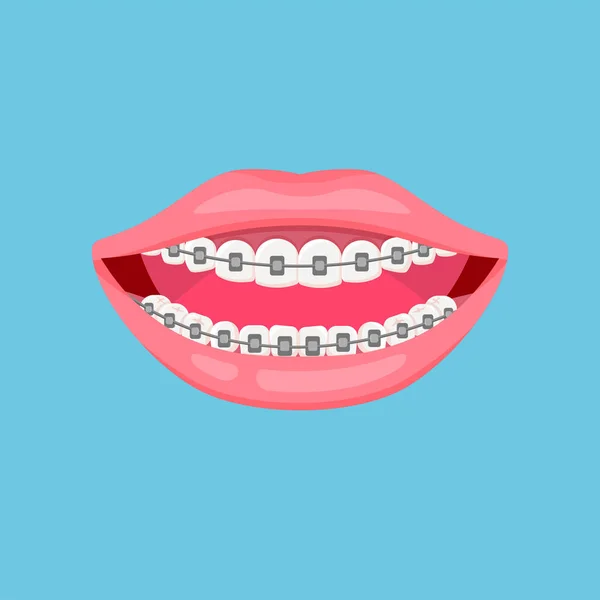 嘴和牙齿都有牙套 牙齿矫正的概念 牙齿的对齐 牙科保健 在蓝色背景上孤立的向量图 — 图库矢量图片
