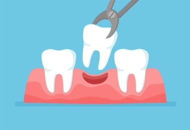 Diş penslerle alınır. Diş implantı olan dişler. Mavi arkaplanda vektör illüstrasyonu izole edildi.