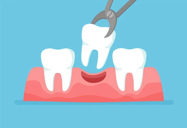 Diente Extrae Con Fórceps Fila Dental Con Implante Dental Ilustración — Archivo Imágenes Vectoriales