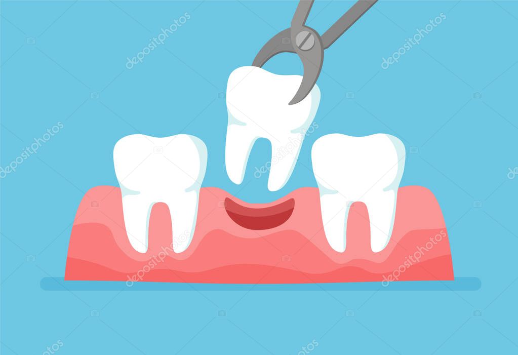 Tooth is removed by forceps. Teeth row with dental implant. Vector illustration isolated on blue background.